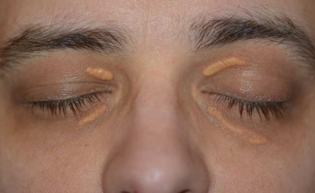Botox anti-wrinkle injection treatments in Brantford, Ontario by Dr. Fadi Calotti