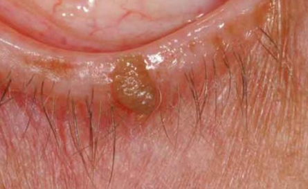 Skin Tag Removal in Brantford, Ontario by Dr. Fadi Calotti